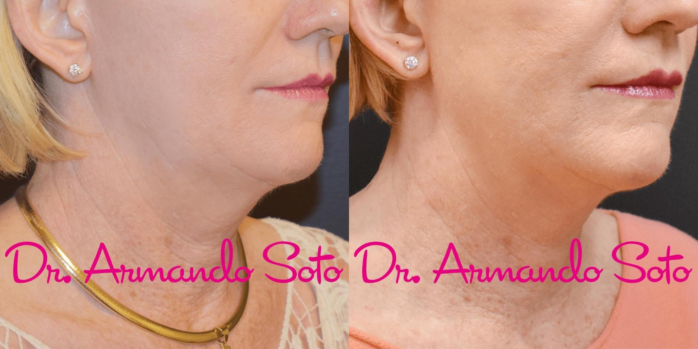 Before & After Deep Focused Ultrasound (Sofwave) Case 42810 View #1 View in Orlando, FL