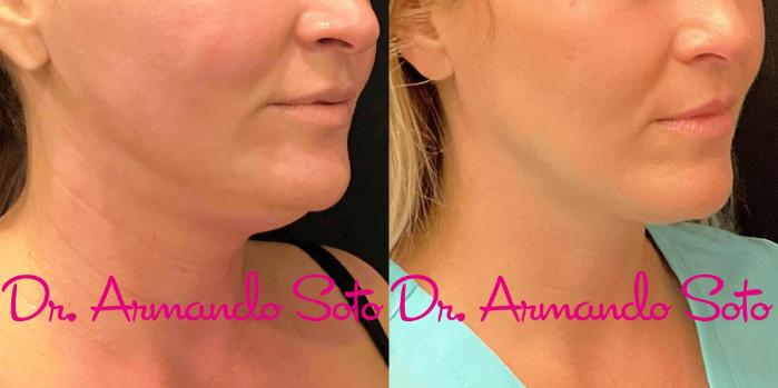 Before & After Deep Focused Ultrasound (Sofwave) Case 73860 View #1 View in Orlando, FL