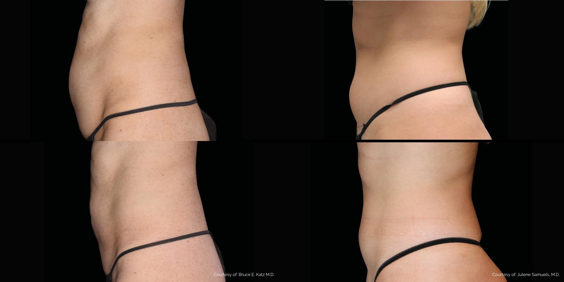 Before & After Emsculpt NEO Case 76298 Left Side View in Orlando, FL