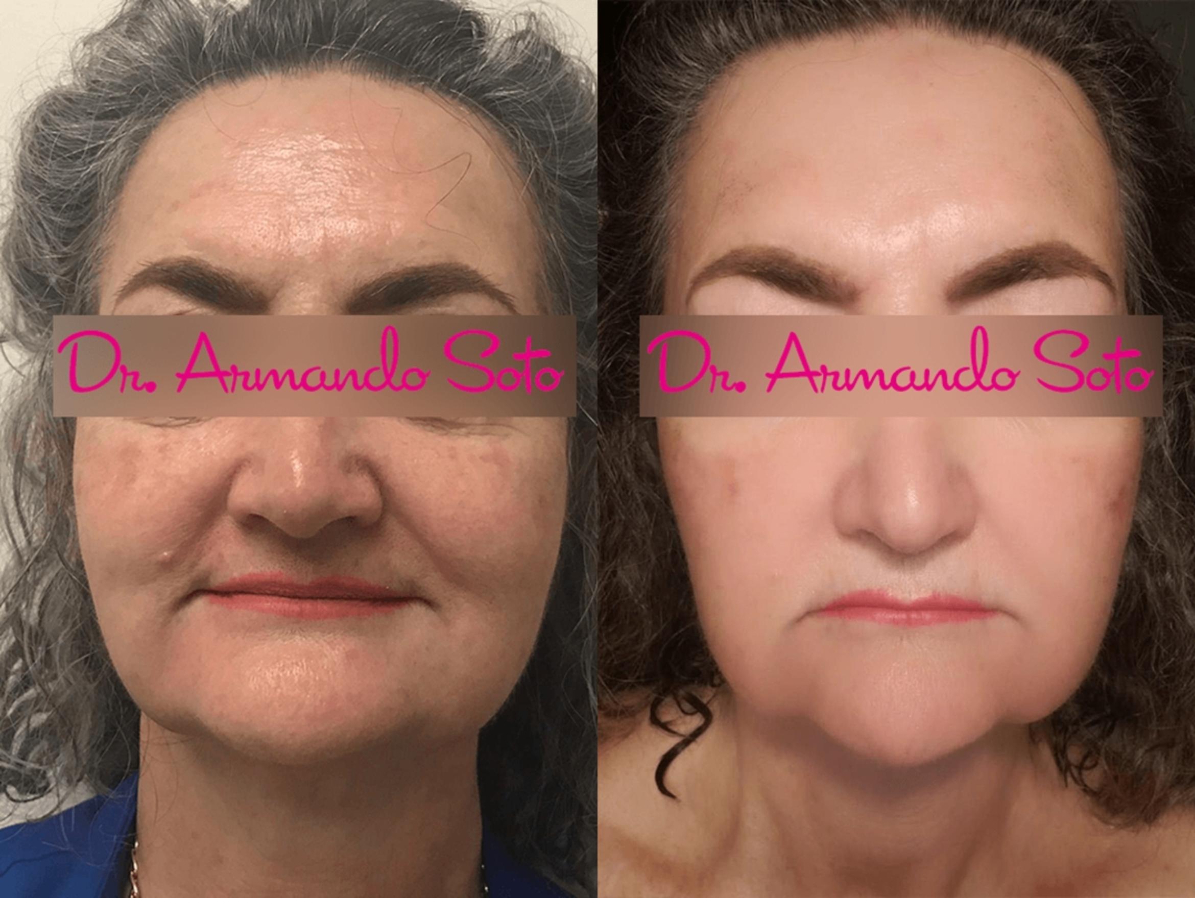 Forever Young® BBL IPL Skin Rejuvenation in Orlando  Aesthetic  Enhancements Plastic Surgery & Laser Center: Armando Soto, MD