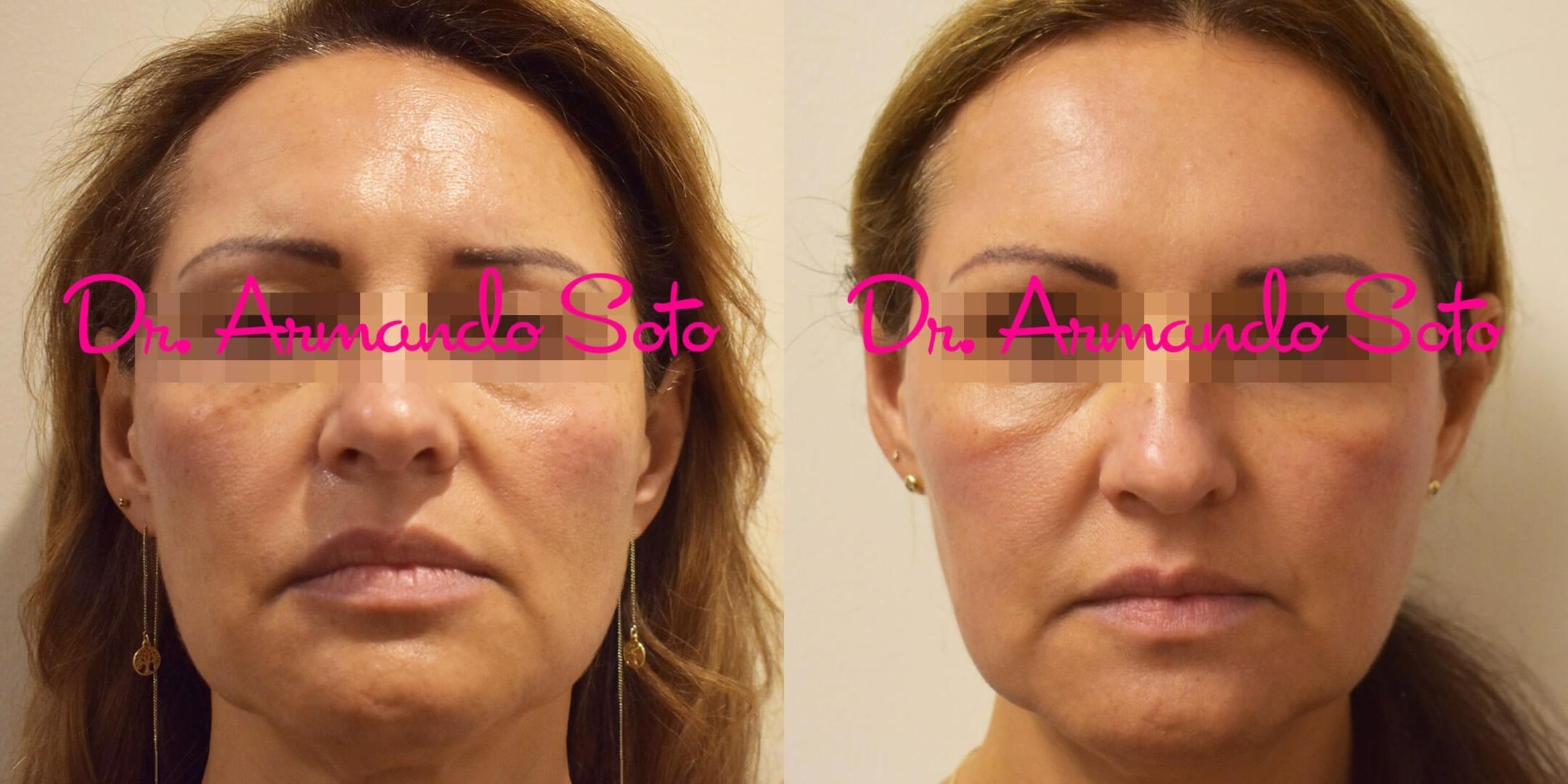 Before & After HALO™ Case 36491 View #1 View in Orlando, FL