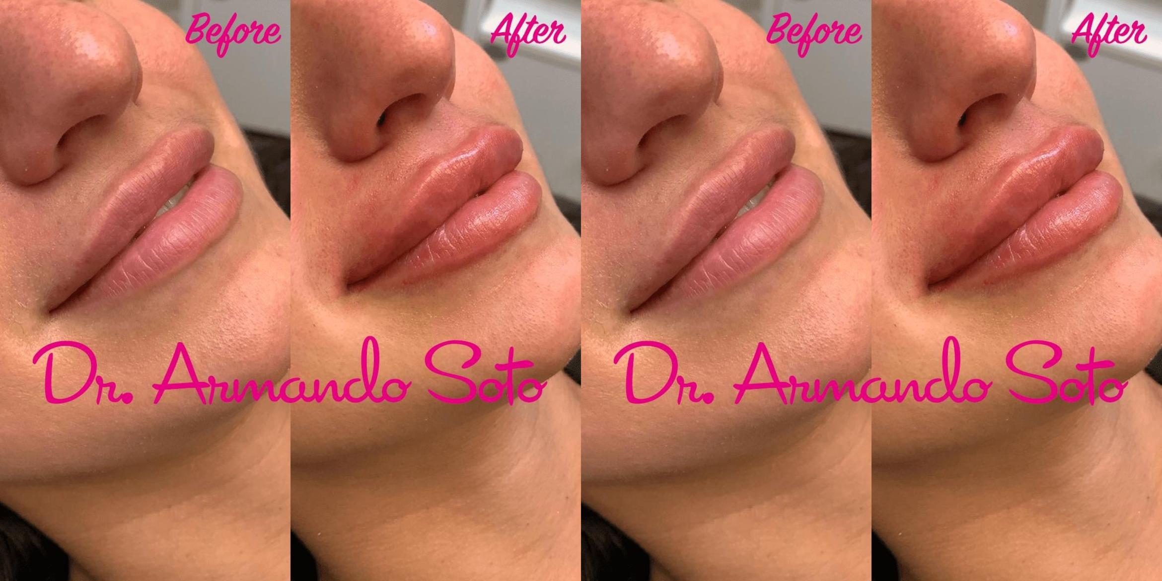 Before & After JUVÉDERM® Case 73495 View #1 View in Orlando, FL