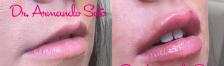 Before & After JUVÉDERM® Case 73501 View #1 View in Orlando, FL
