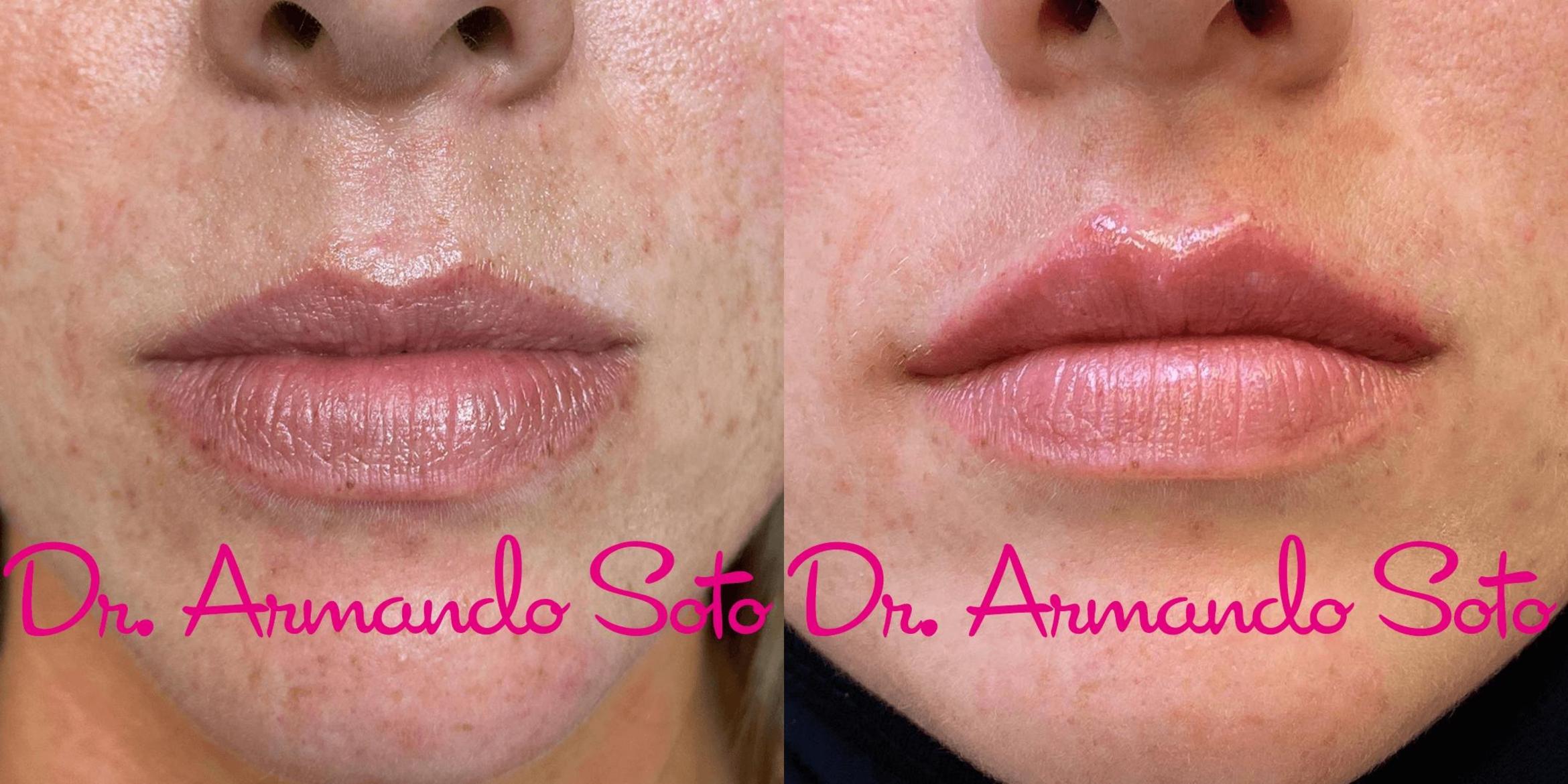 Before & After JUVÉDERM® Case 73953 View #1 View in Orlando, FL