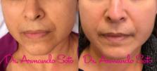 Before & After Laser Skin Rejuvenation Case 71939 View #1 View in Orlando, FL