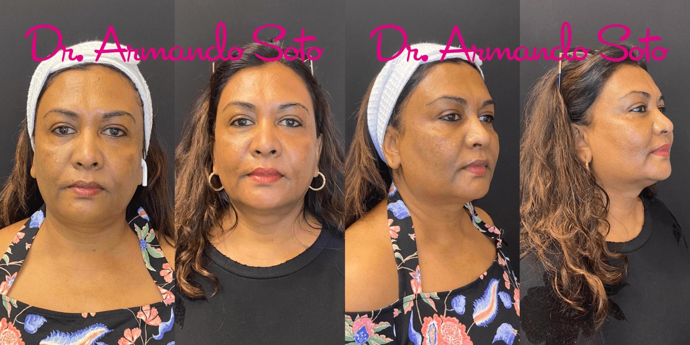 Before & After Laser Skin Rejuvenation Case 75062 View #1 View in Orlando, FL