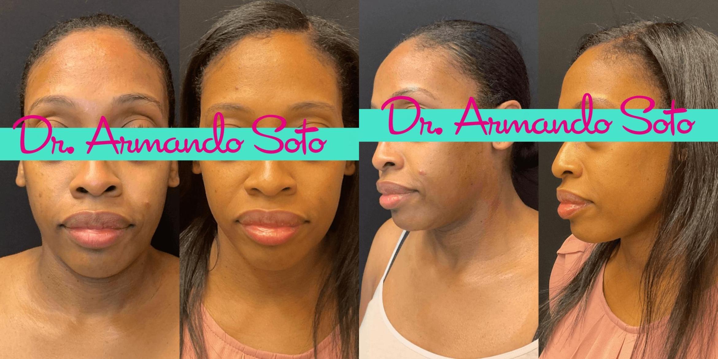 Before & After Laser Skin Rejuvenation Case 76174 View #1 View in Orlando, FL