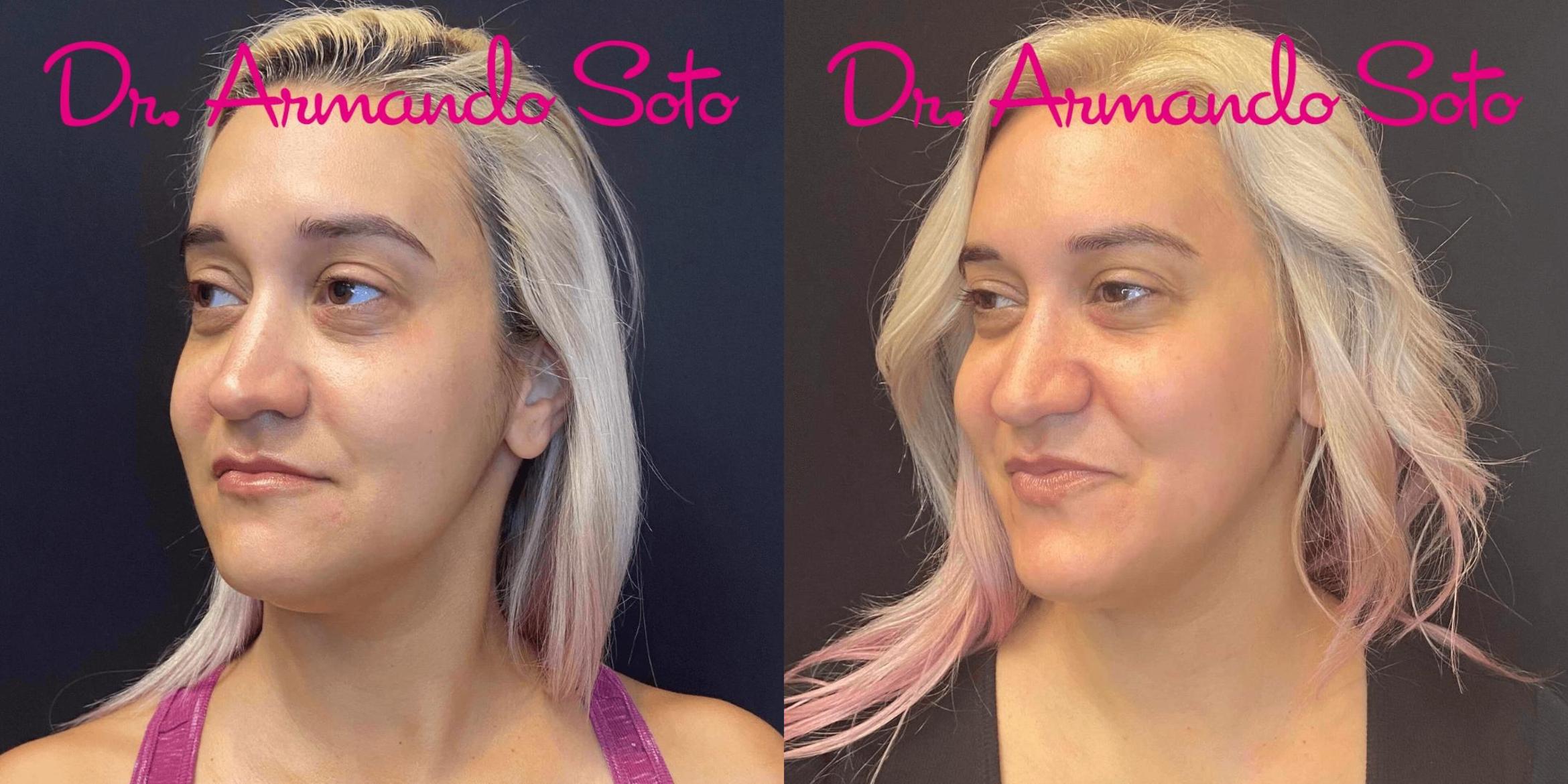 Before & After Laser Skin Rejuvenation Case 76268 View #1 View in Orlando, FL