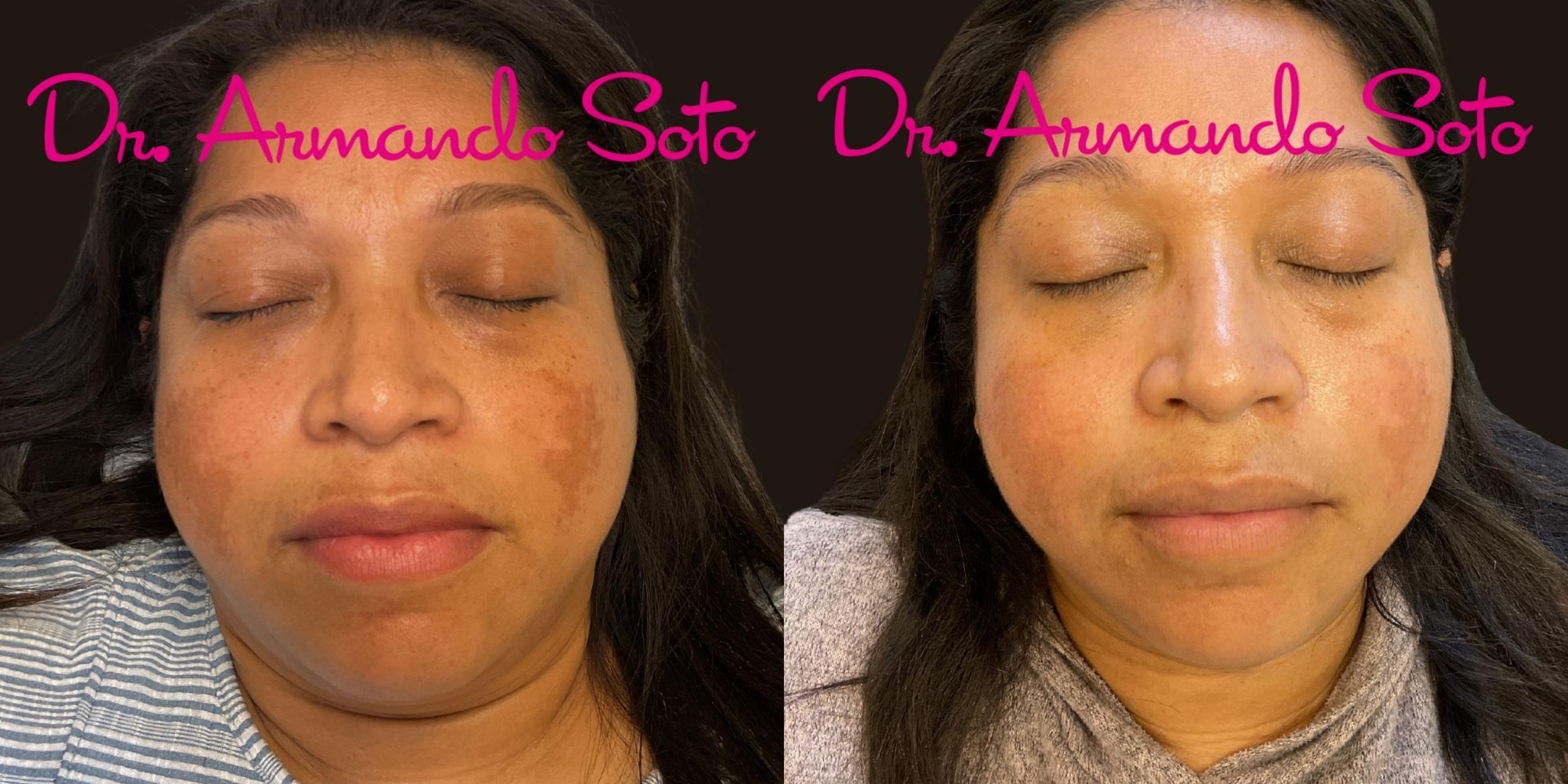 Before & After Laser Skin Rejuvenation Case 76275 Front View in Orlando, FL