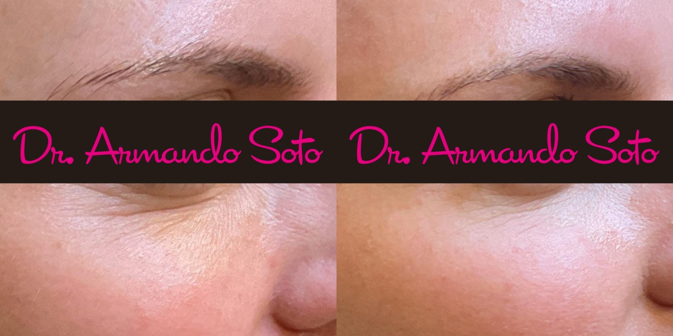 Before & After Laser Skin Rejuvenation Case 76276 Right Oblique View in Orlando, FL