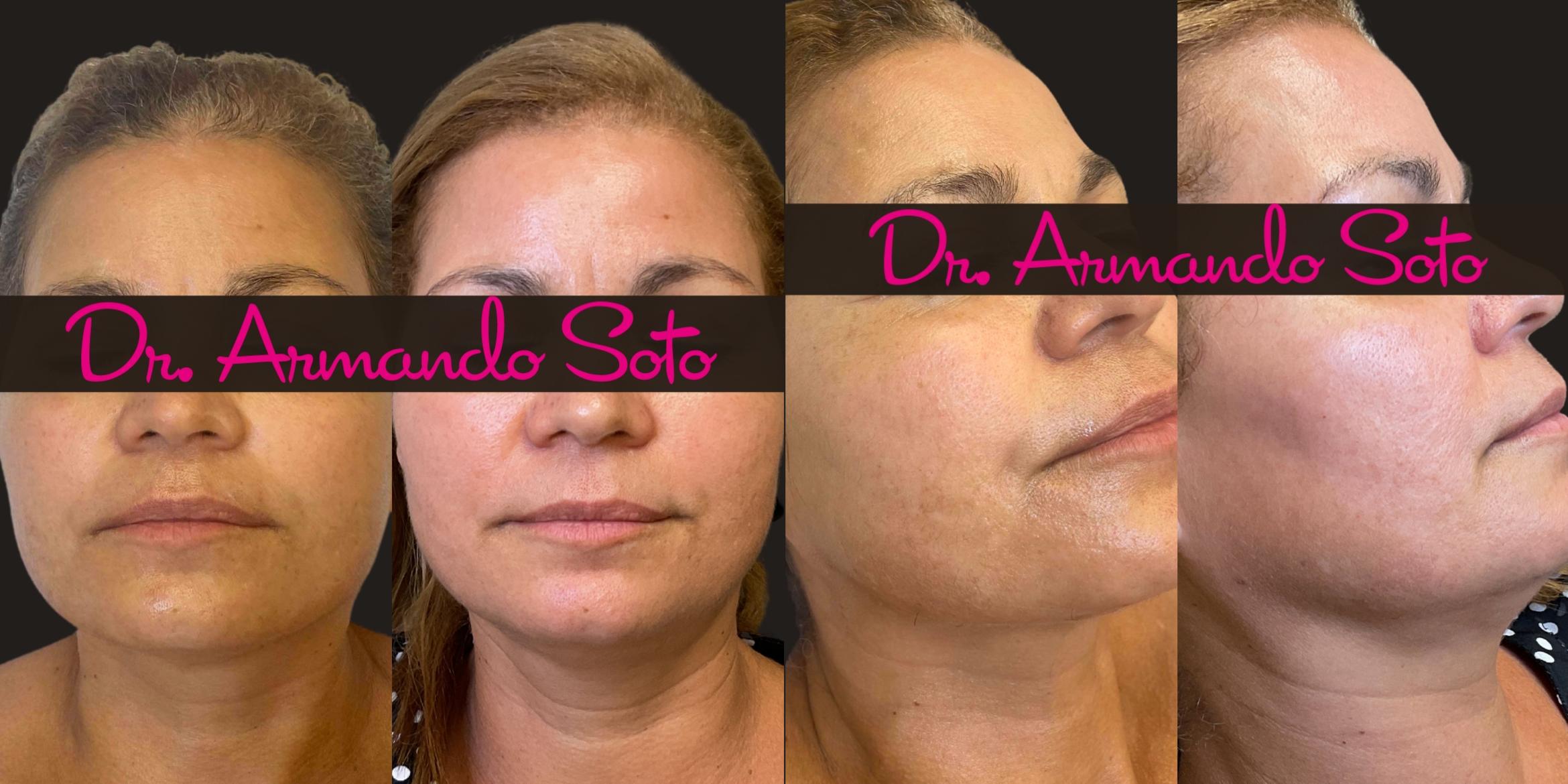 Before and After Moxi laser treatment by Dr. Armando Soto at