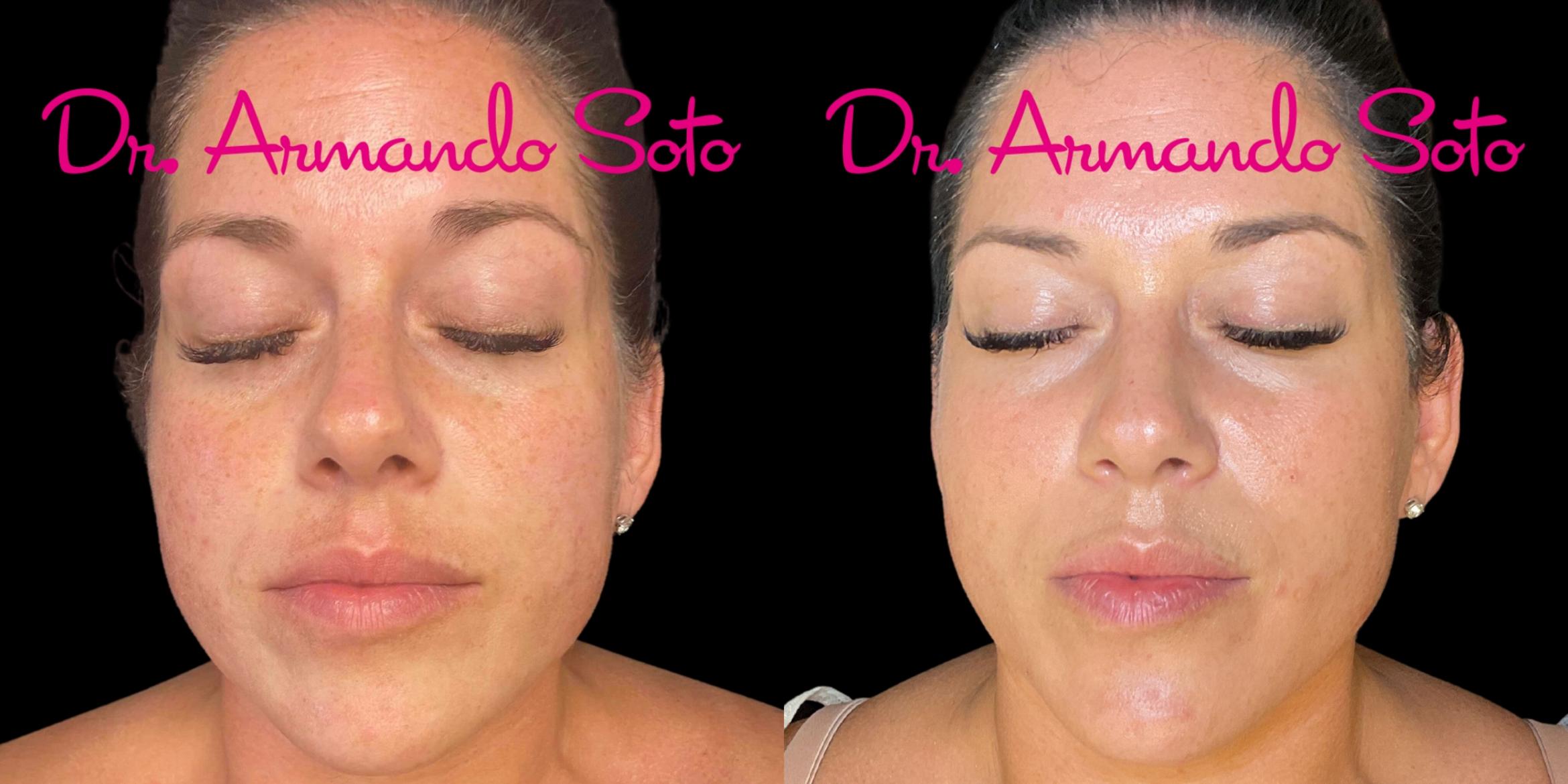 Before & After Laser Skin Rejuvenation Case 76290 Front View in Orlando, FL