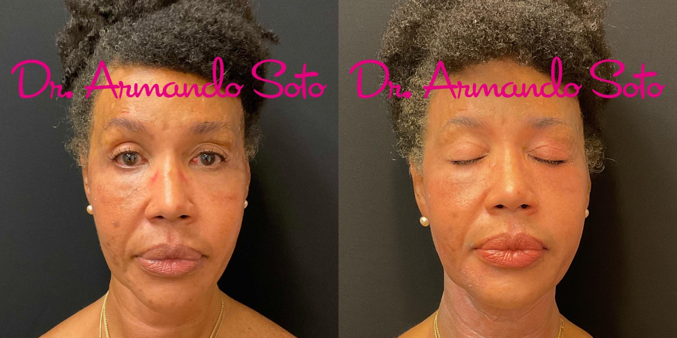 Before & After Laser Skin Rejuvenation Case 76291 Front View in Orlando, FL