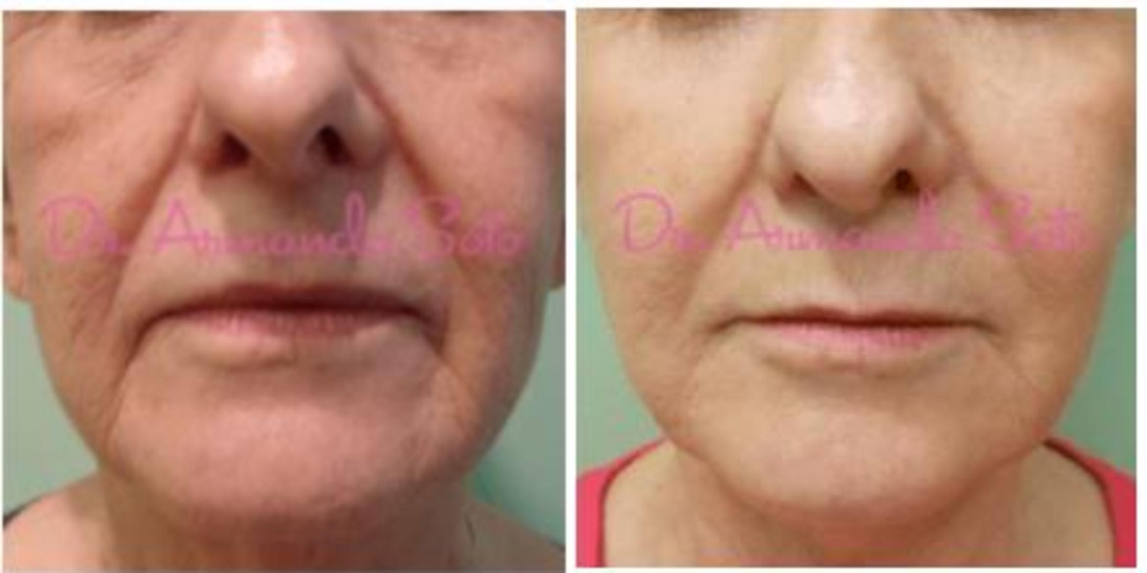 Laser Skin Resurfacing Before and After Pictures Case 23460