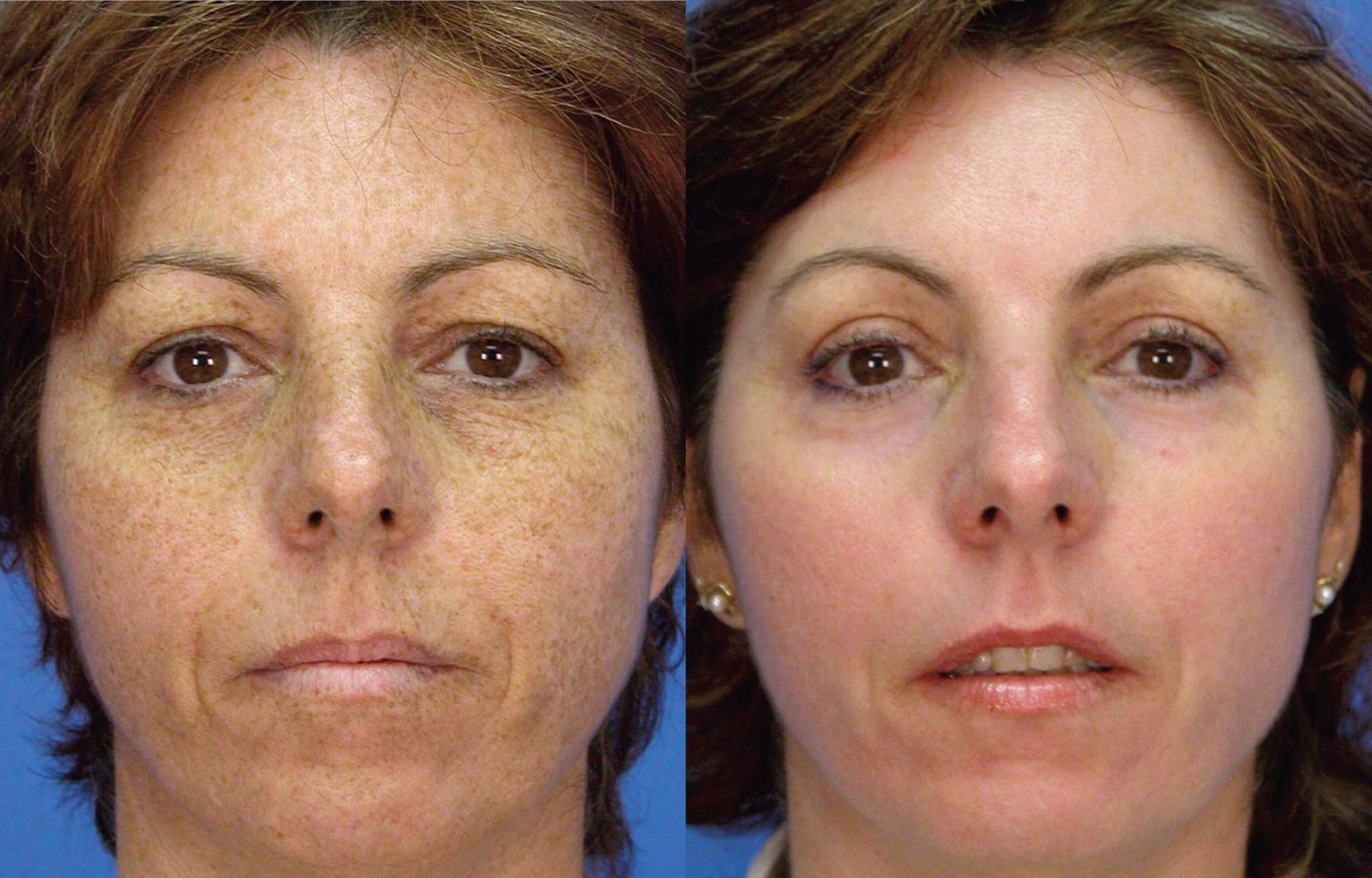 Before & After Laser Skin Resurfacing Case 28545 View #1 View in Orlando, FL
