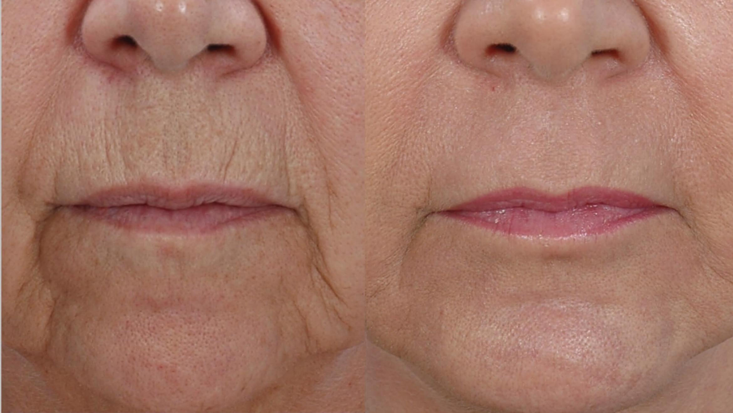 Before & After Laser Skin Resurfacing Case 28546 View #1 View in Orlando, FL