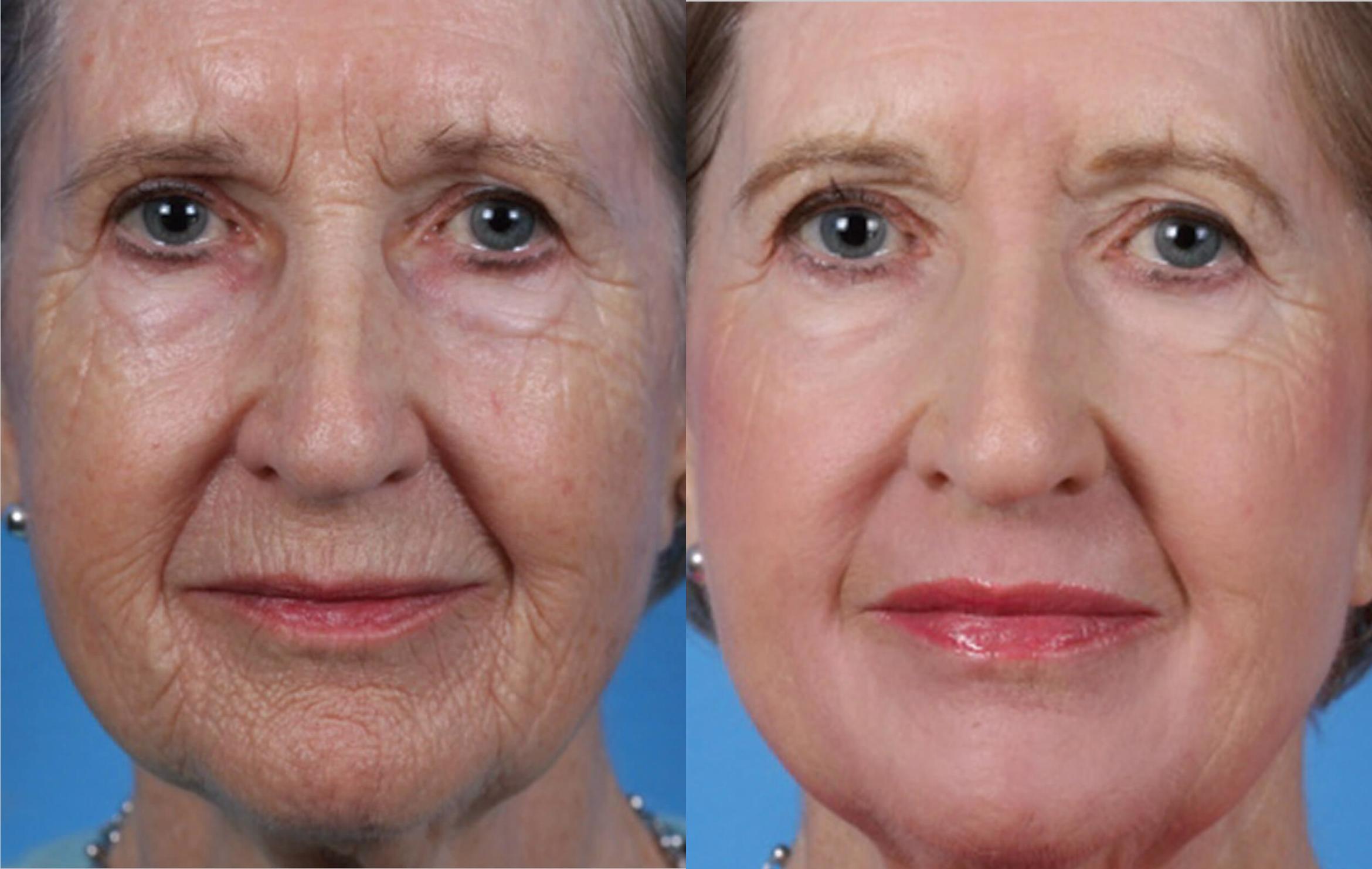 Before & After Laser Skin Resurfacing Case 28547 View #1 View in Orlando, FL