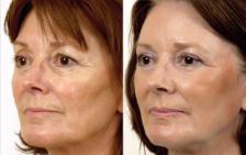 Before & After Laser Skin Resurfacing Case 28548 View #1 View in Orlando, FL