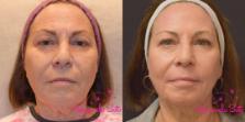 Before & After Laser Skin Resurfacing Case 46481 View #1 View in Orlando, FL