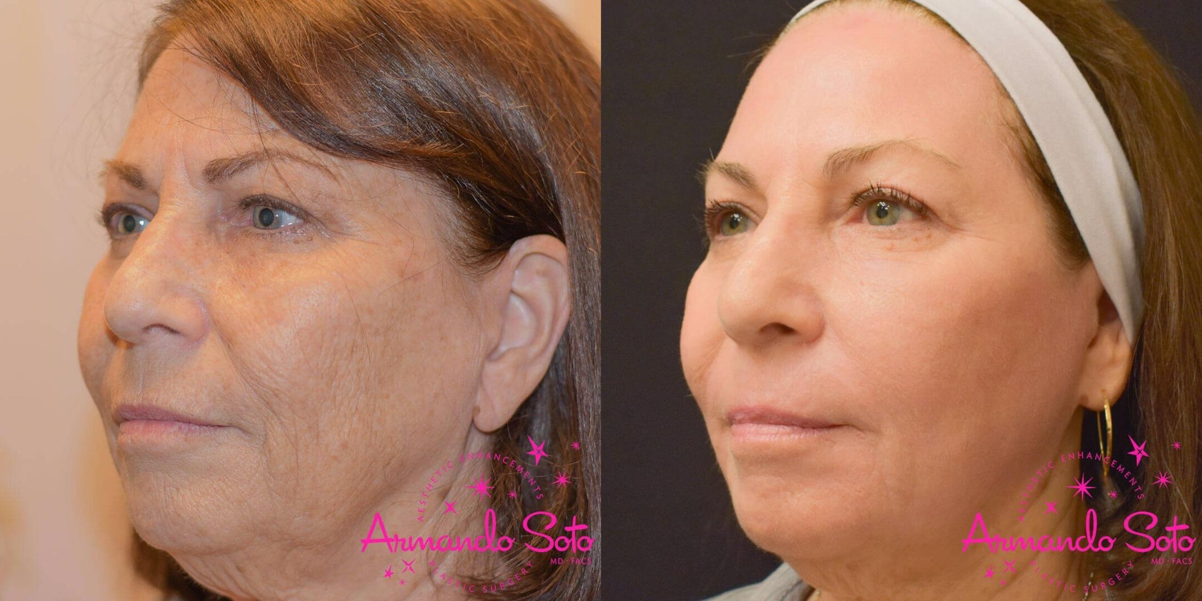 Before & After Laser Skin Resurfacing Case 46481 View #2 View in Orlando, FL