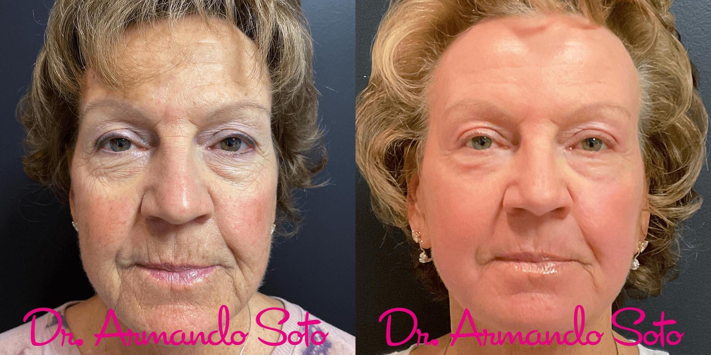 Before & After Laser Skin Resurfacing Case 73438 View #1 View in Orlando, FL