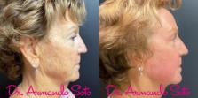 Before & After Laser Skin Resurfacing Case 73438 View #2 View in Orlando, FL