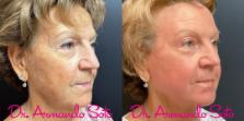 Before & After Laser Skin Resurfacing Case 73438 View #3 View in Orlando, FL