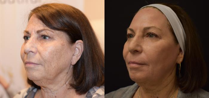 Before & After Laser Skin Resurfacing Case 76352 Left Side View in Orlando, FL