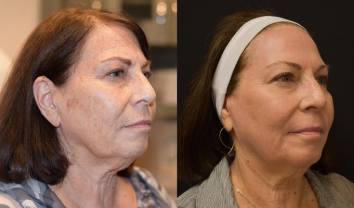 Female Patient shown before Laser Skin Resurfacing by Dr. Armando Soto