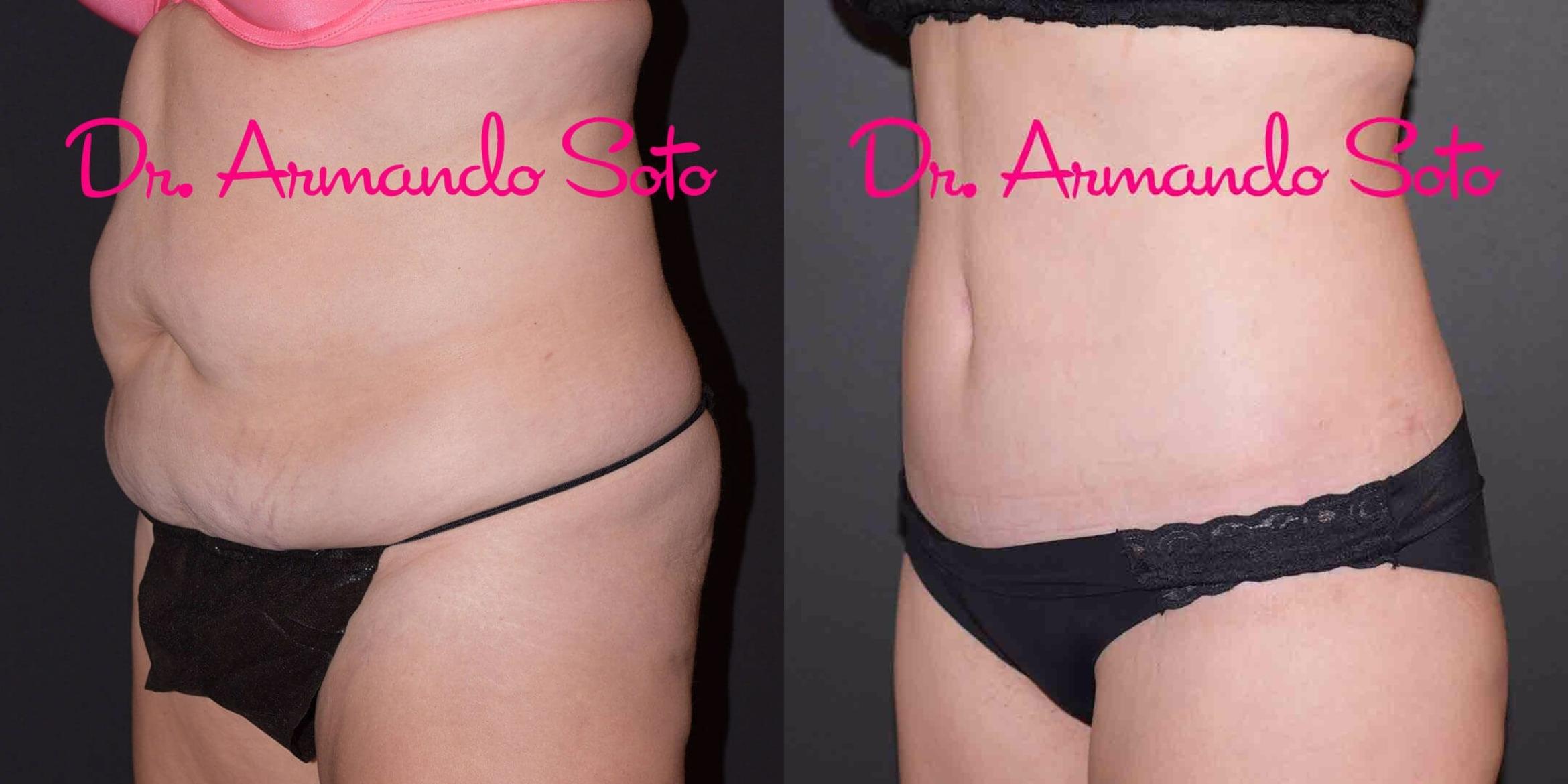 Before & After Liposuction Case 49389 View #2 View in Orlando, FL