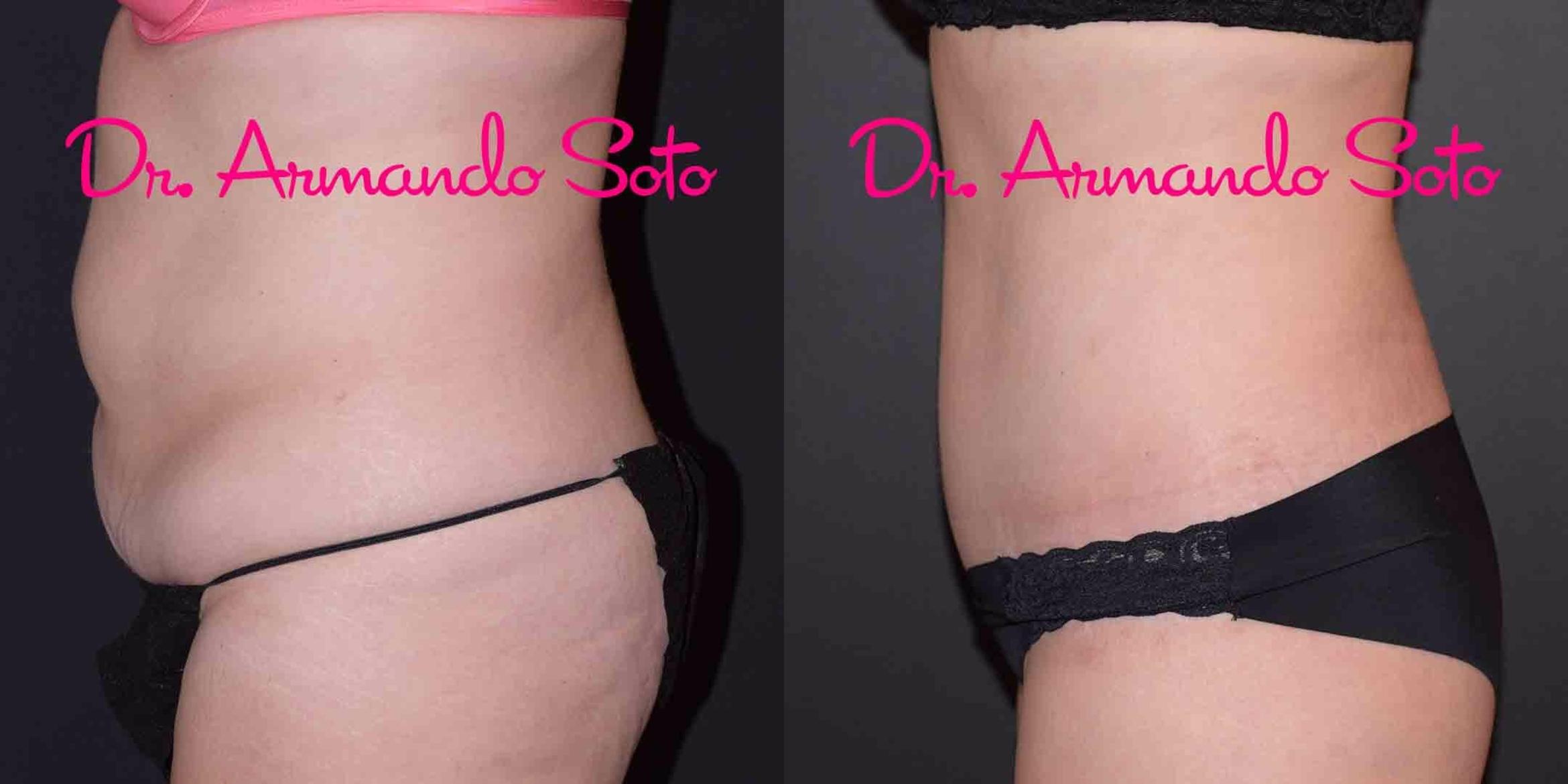 Before & After Liposuction Case 49389 View #3 View in Orlando, FL