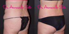 Before & After Liposuction Case 49389 View #4 View in Orlando, FL