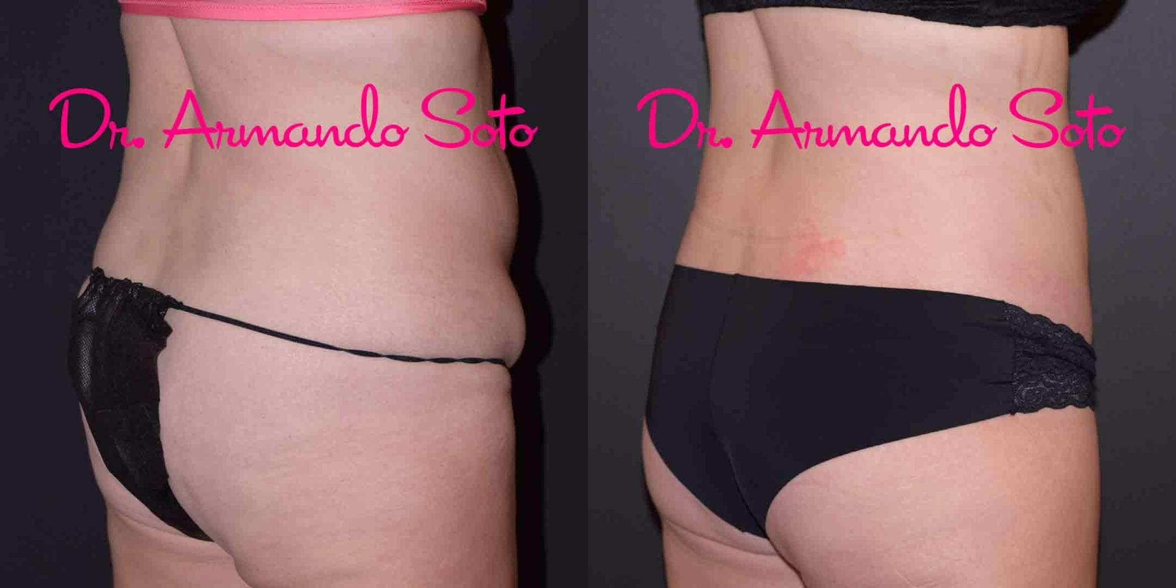 Before & After Liposuction Case 49389 View #6 View in Orlando, FL