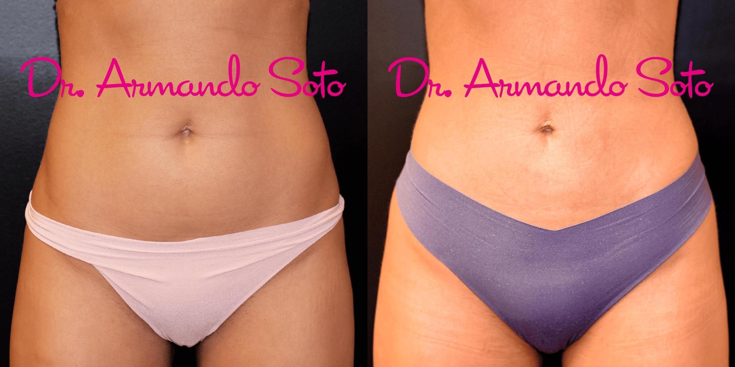 Before & After Liposuction Case 67001 View #1 View in Orlando, FL