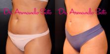 Before & After Liposuction Case 67001 View #2 View in Orlando, FL