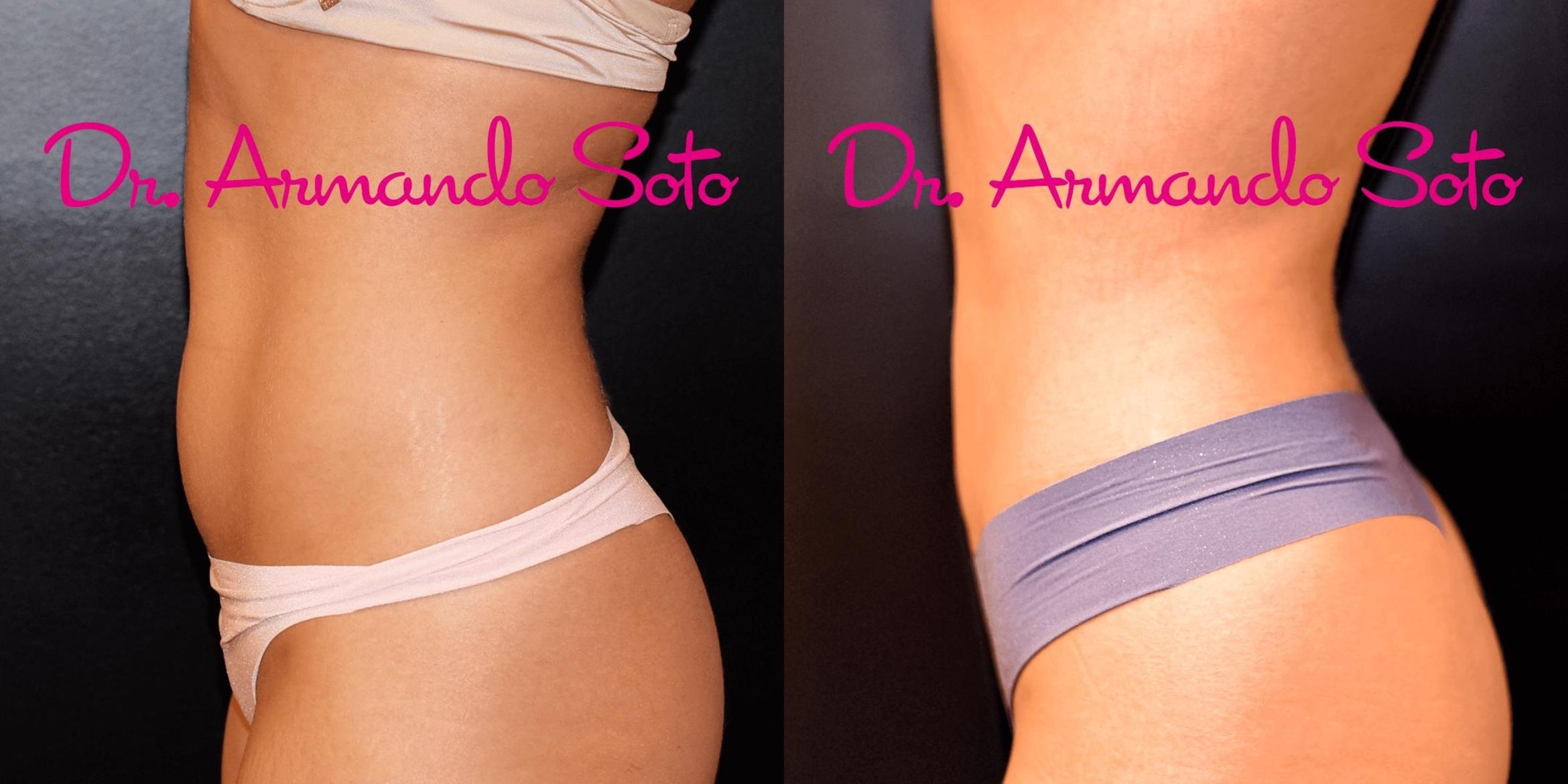 Before & After Liposuction Case 67001 View #3 View in Orlando, FL