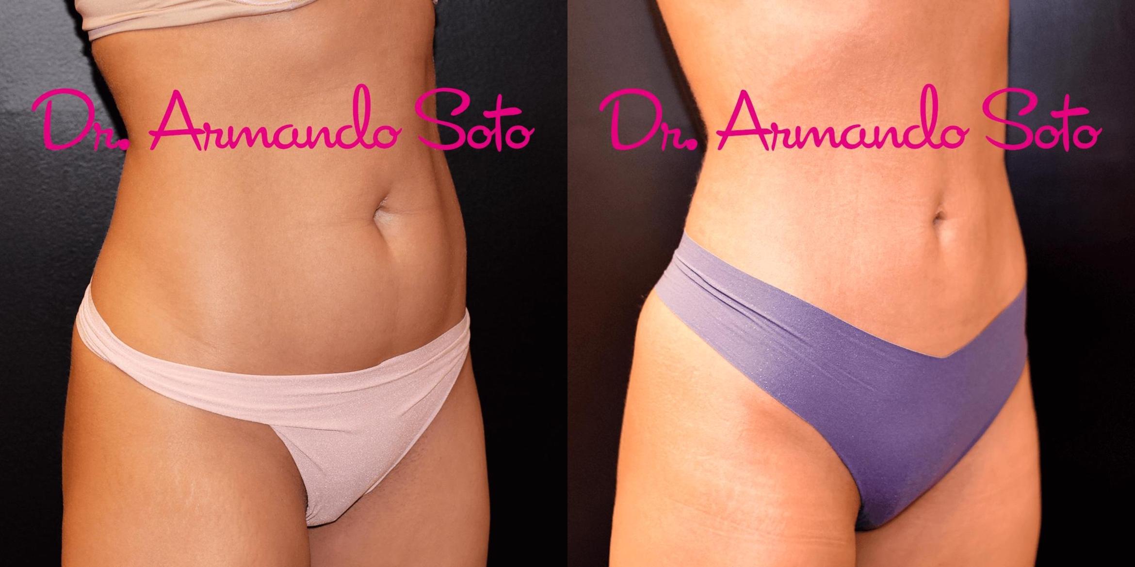 Before & After Liposuction Case 67001 View #4 View in Orlando, FL
