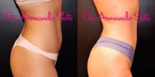 Before & After Liposuction Case 67001 View #5 View in Orlando, FL