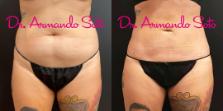 Before & After Liposuction Case 70555 View #1 View in Orlando, FL