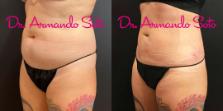 Before & After Liposuction Case 70555 View #2 View in Orlando, FL