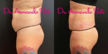 Before & After Liposuction Case 70555 View #3 View in Orlando, FL