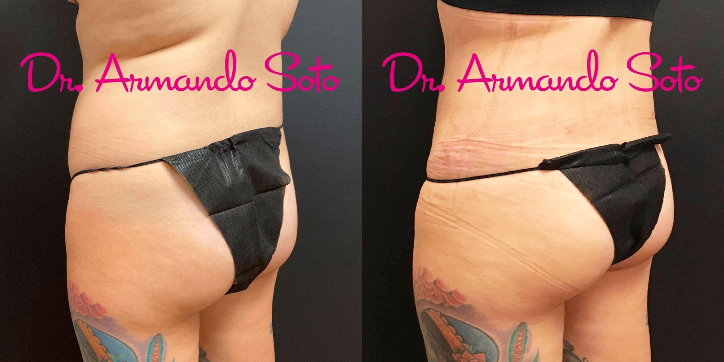Before & After Liposuction Case 70555 View #4 View in Orlando, FL