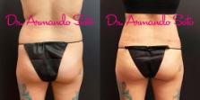 Before & After Liposuction Case 70555 View #5 View in Orlando, FL
