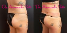 Before & After Liposuction Case 70555 View #6 View in Orlando, FL