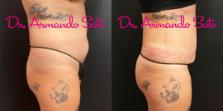 Before & After Liposuction Case 70555 View #7 View in Orlando, FL