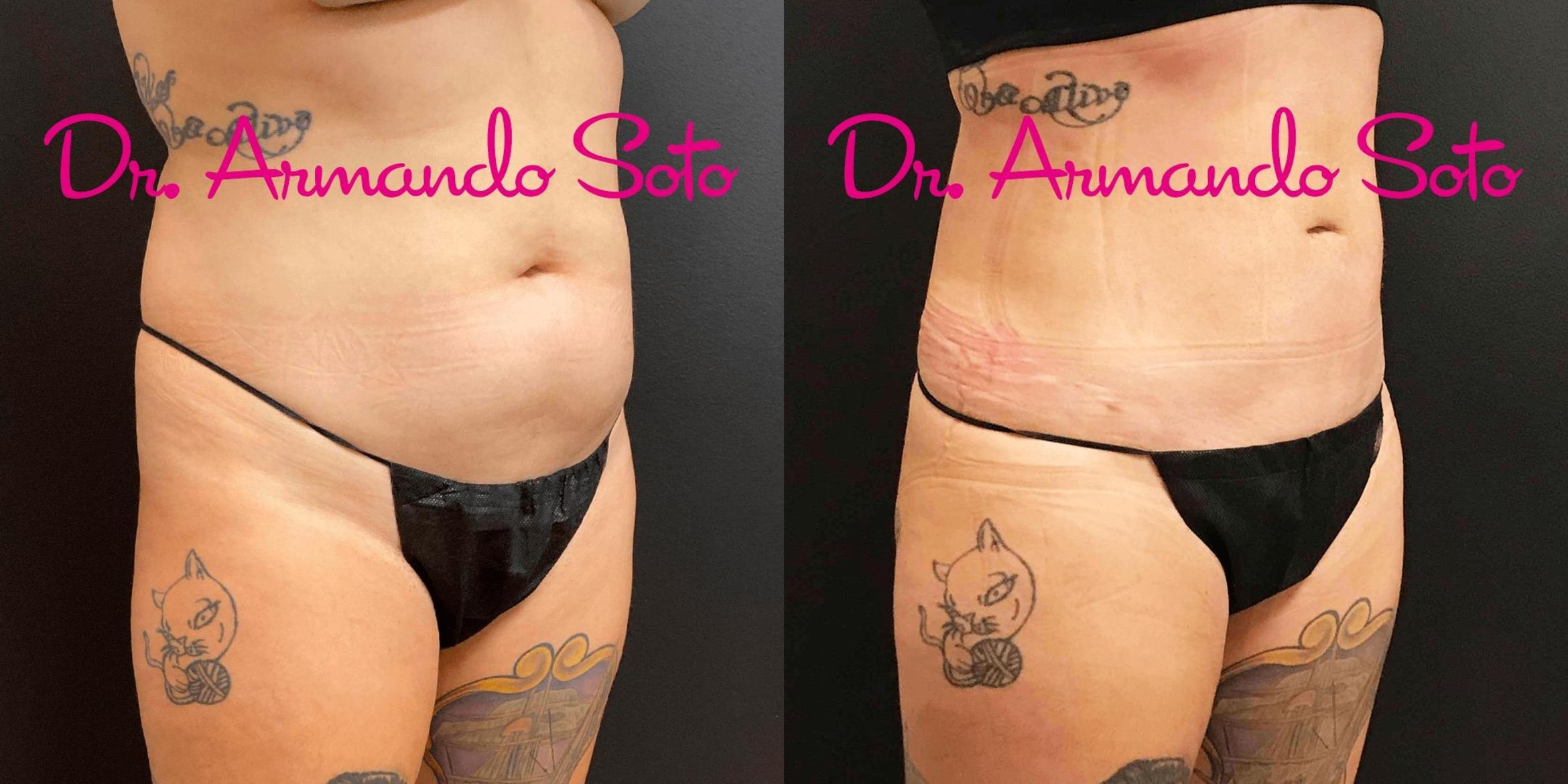 Before & After Liposuction Case 70555 View #8 View in Orlando, FL