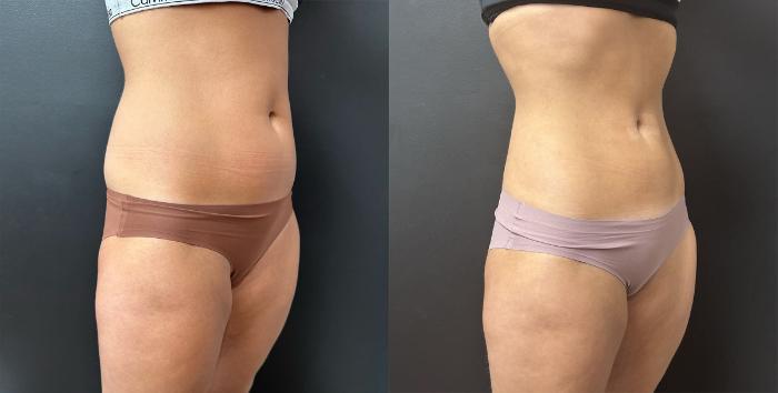 Before & After Liposuction Case 76331 Right Oblique View in Orlando, FL