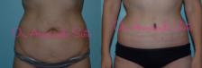 Before & After Lower Body Lift Case 23382 View #1 View in Orlando, FL