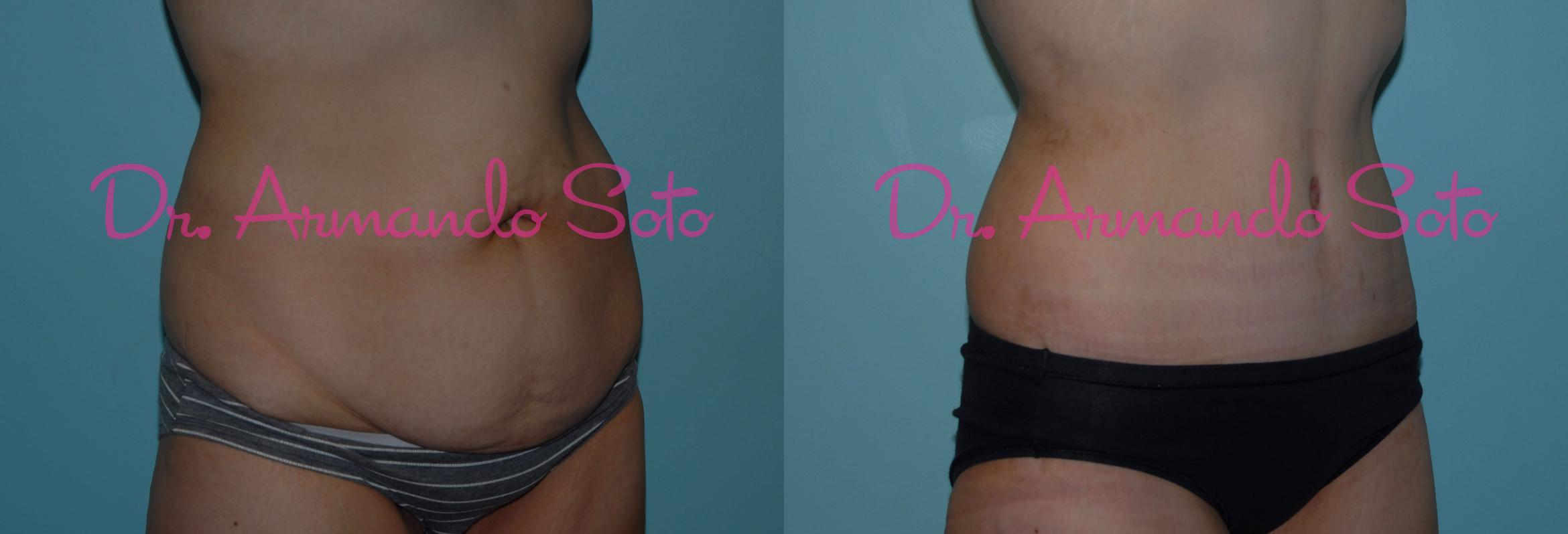 Before & After Lower Body Lift Case 23382 View #2 View in Orlando, FL