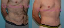 Before & After Lower Body Lift Case 23447 View #1 View in Orlando, FL